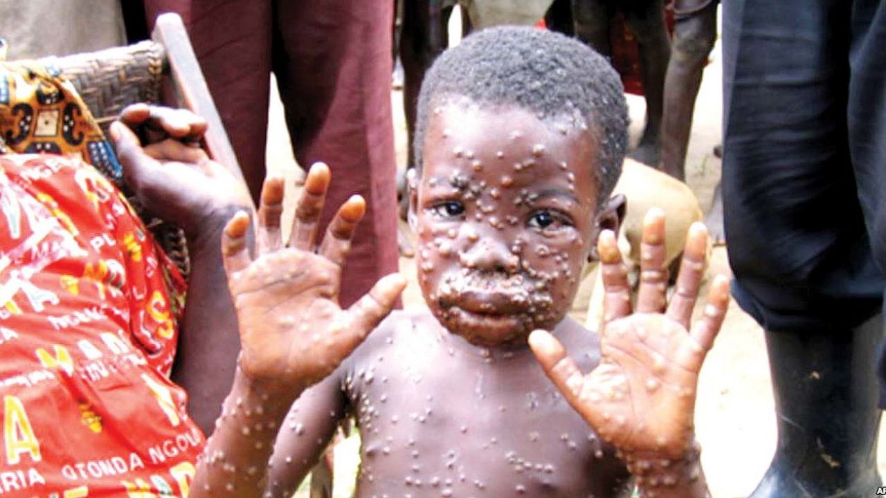 Aseguran que el riesgo de que la “viruela del mono” se vuelva pandemia es muy bajo