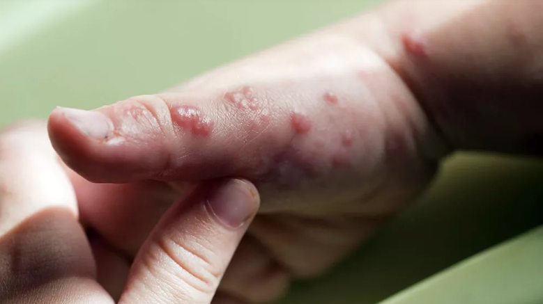 Difunden recomendaciones ante la aparición de síntomas de viruela símica