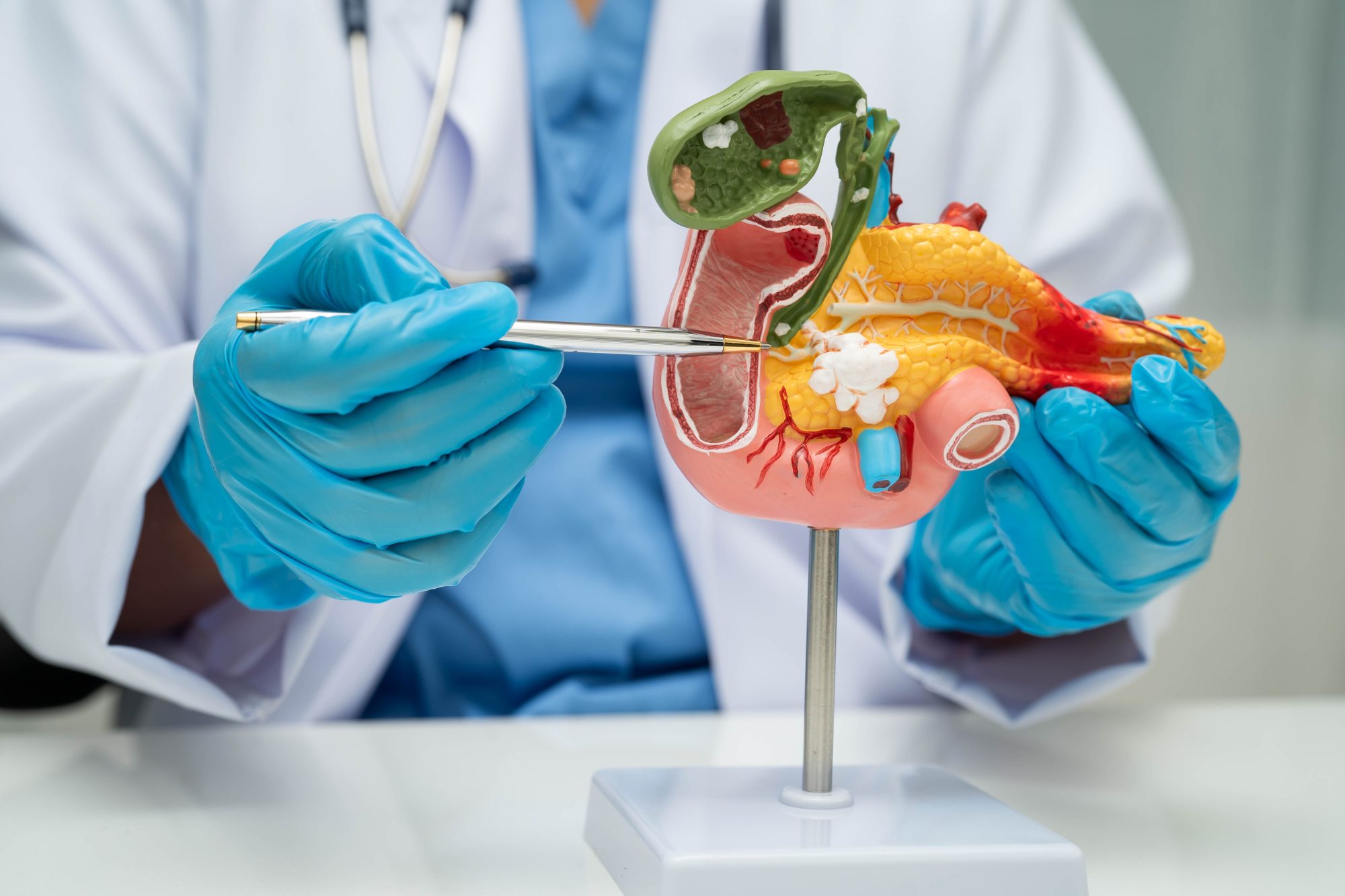 Cáncer de páncreas: Científicos españoles lograron eliminarlo en un estudio con ratones